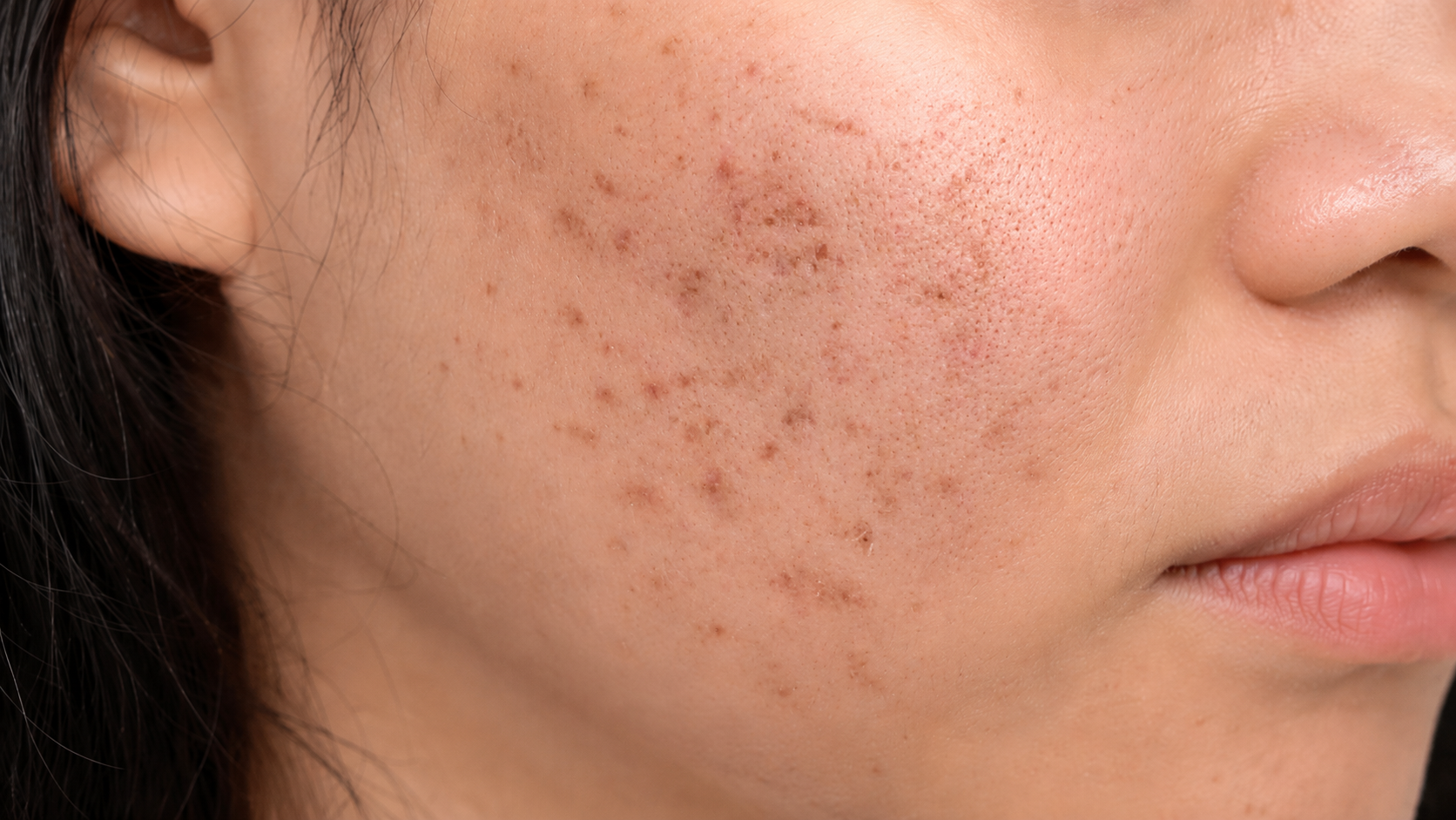 Acne scars & sensitive skin