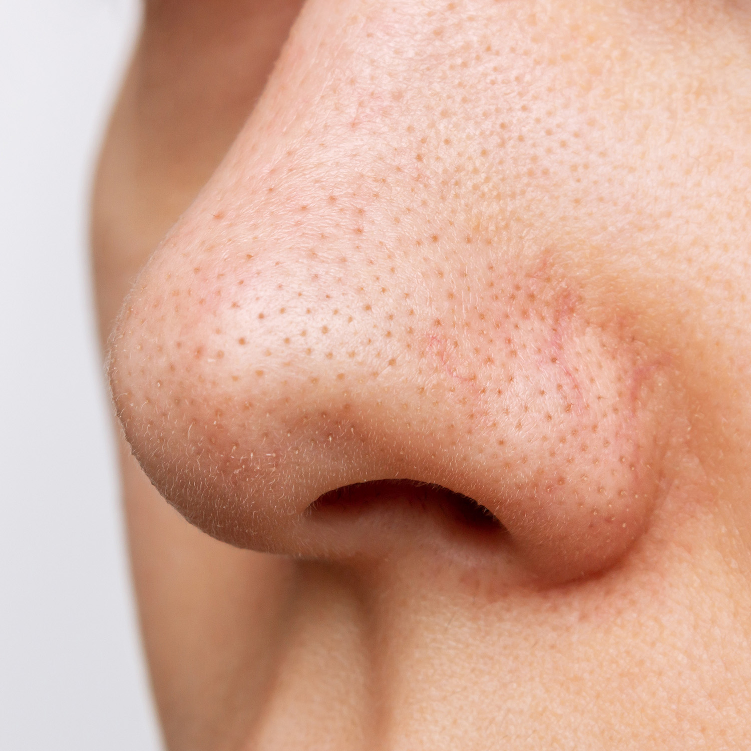 Blackheads (Open Comedones)