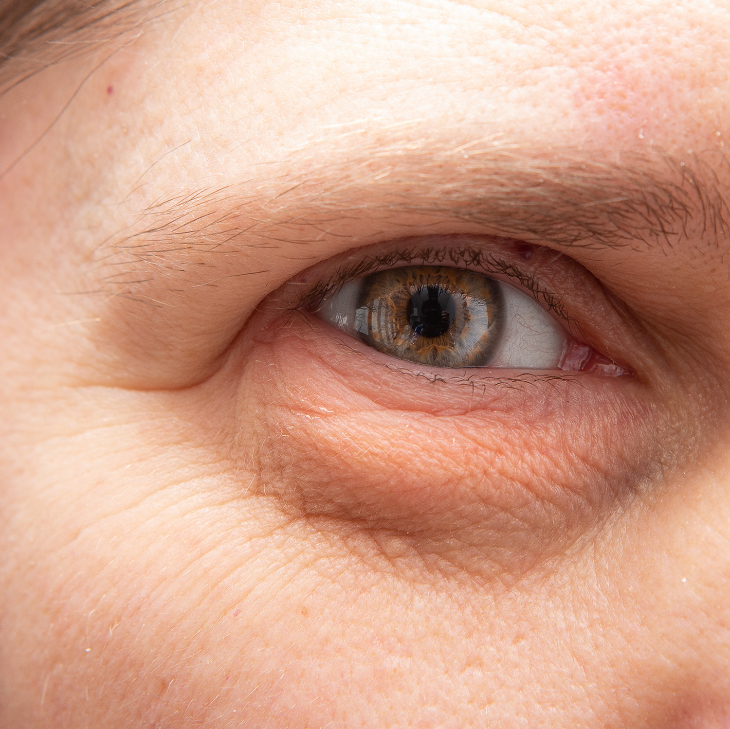 Fine lines & loss of elasticity