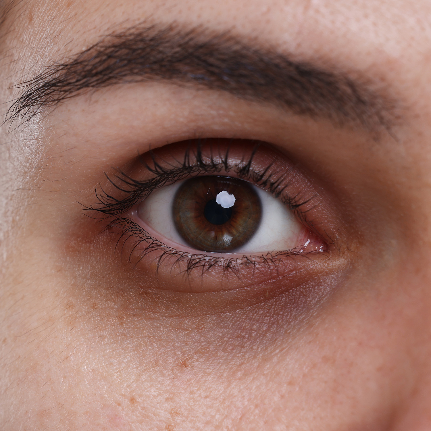 Volume loss & skin thinning