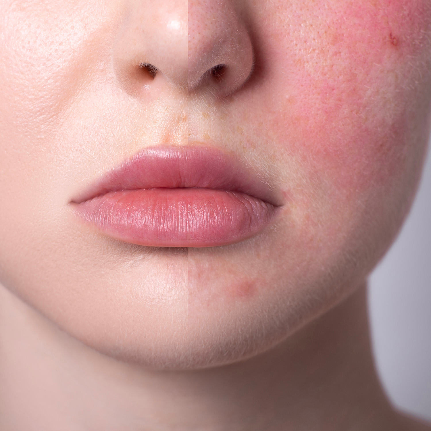 Dehydrated Skin