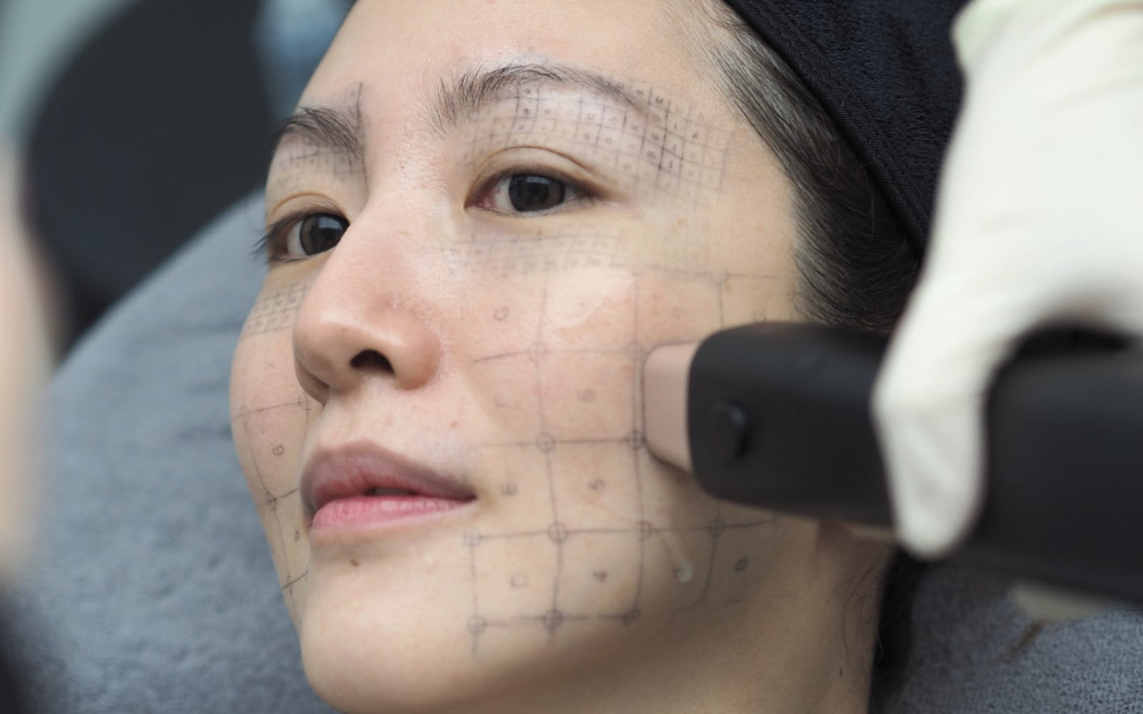 Density RF vs Ultherapy / HIFU: How to Choose the Right Lifting Treatment