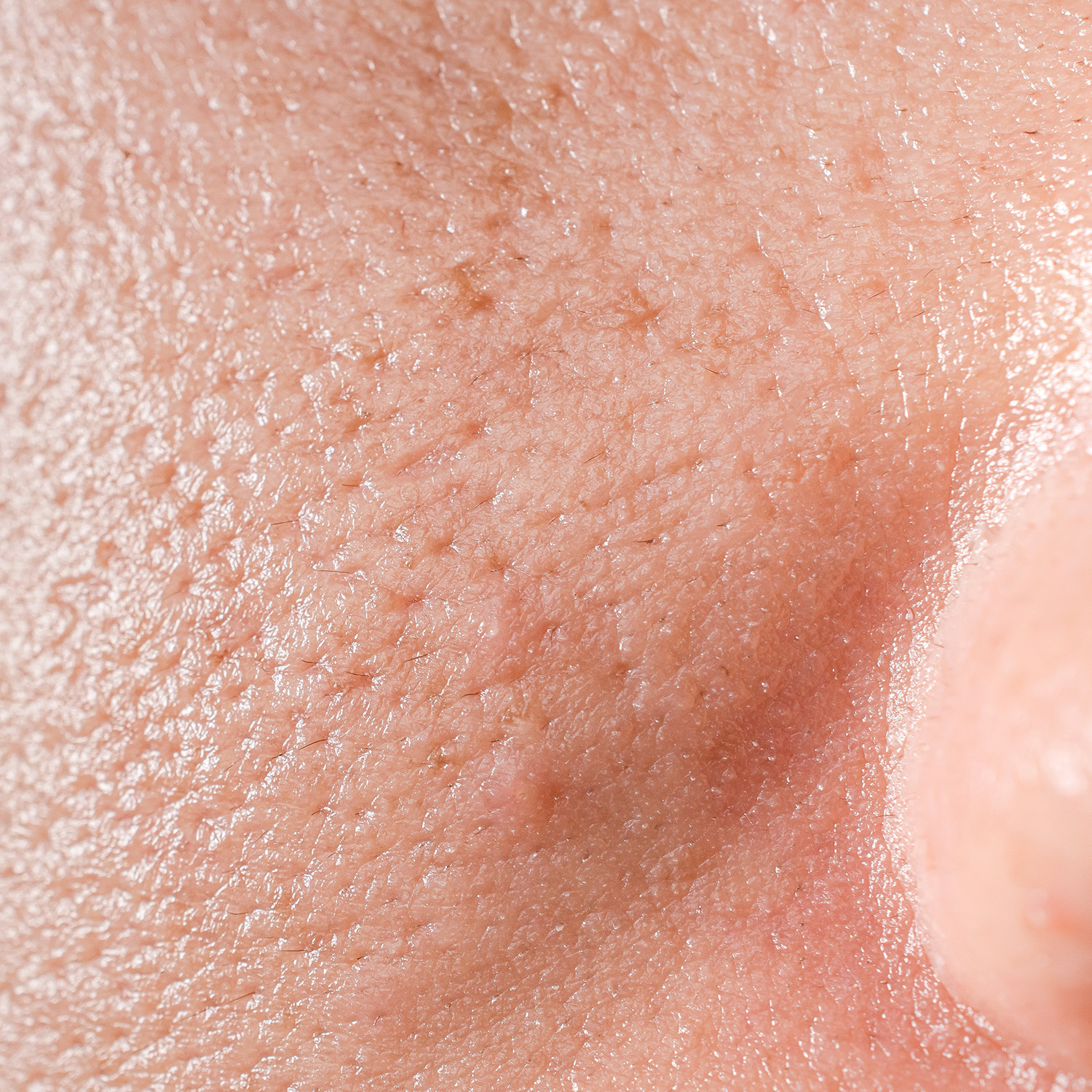 Excess Sebum Production