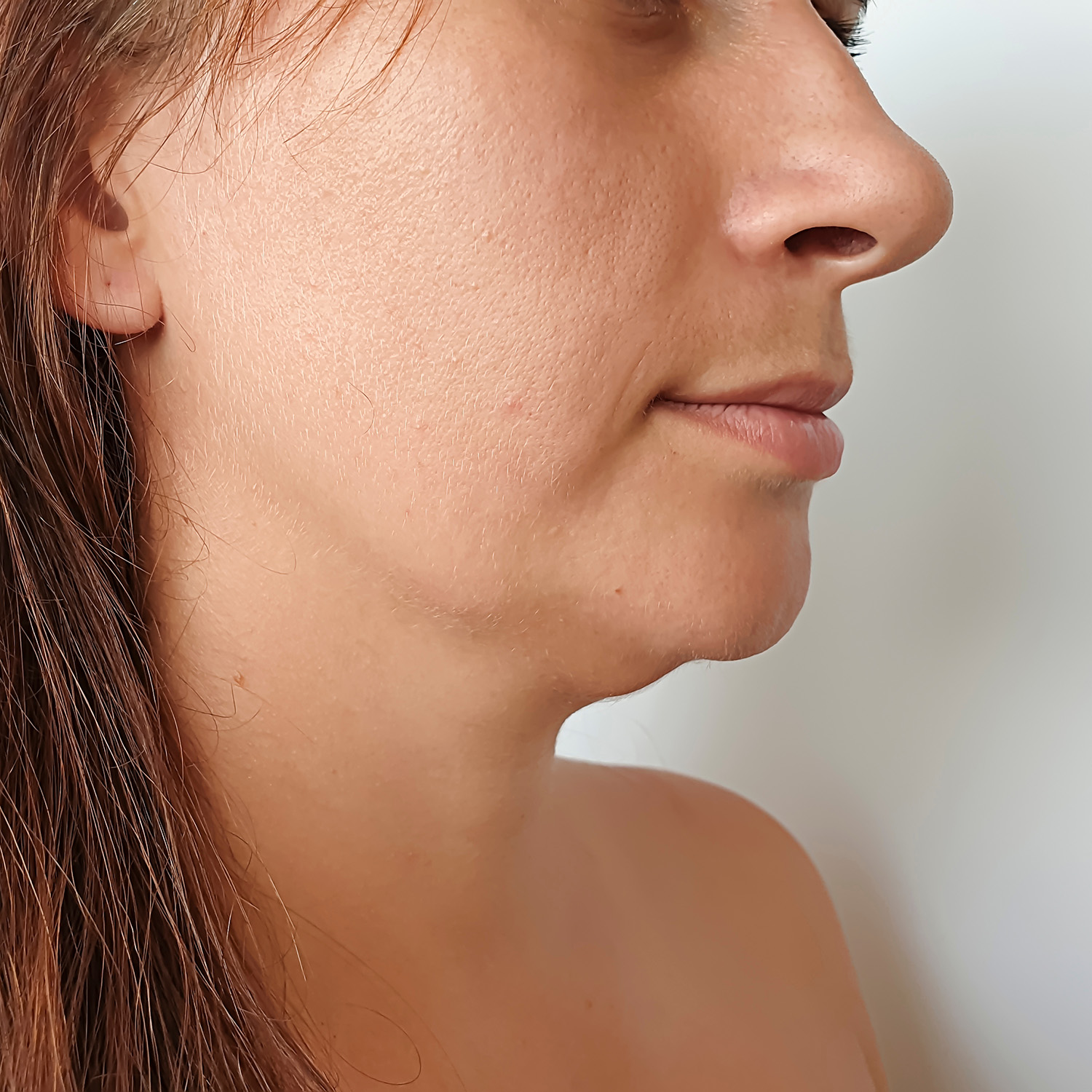 Excess Submental Fat