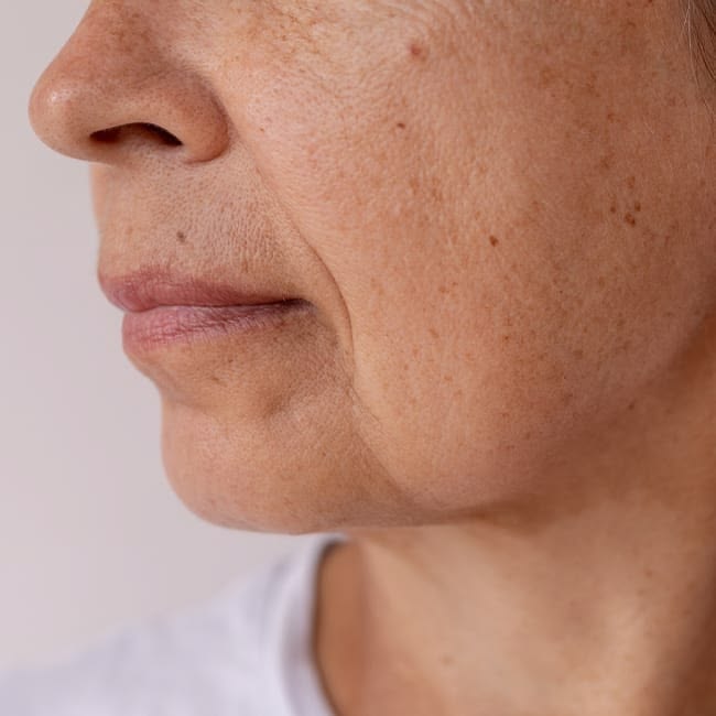Mild to moderate skin laxity