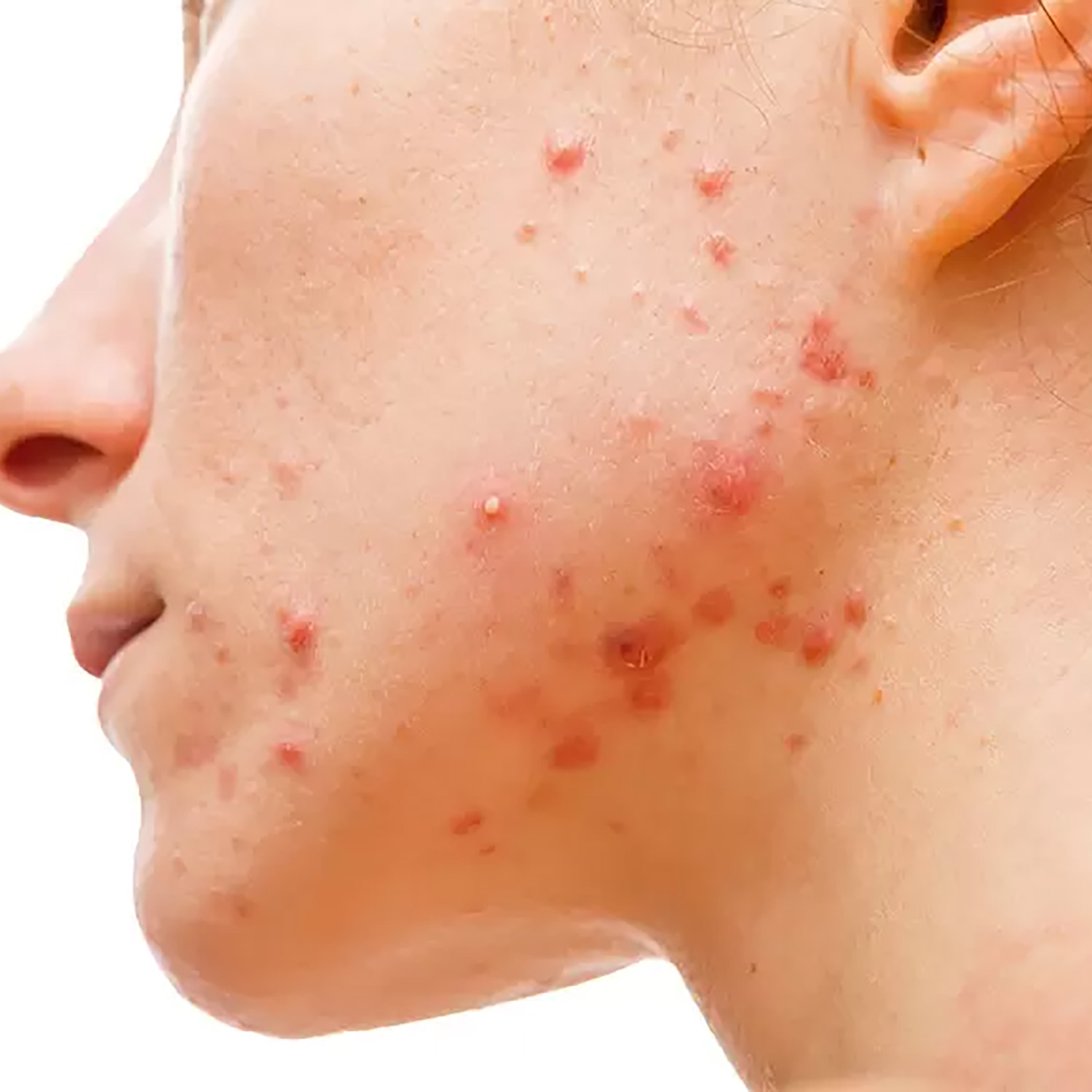 Acne & active breakouts