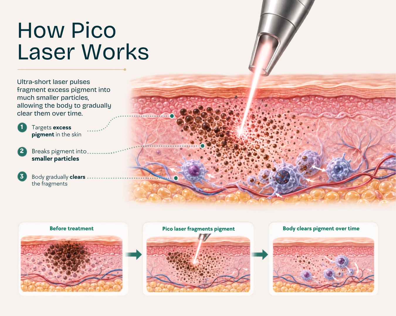 Diagram showing how pico laser targets excess pigment, breaks it into smaller particles, and the body gradually clears the fragments