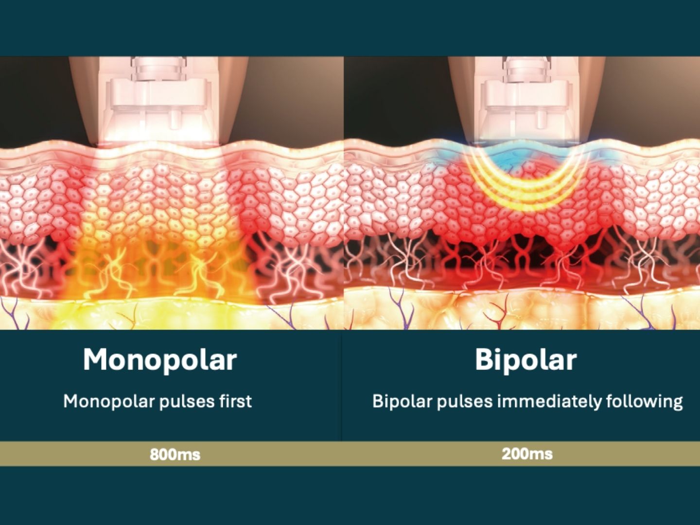 Diagram comparing monopolar radiofrequency pulsing at 800ms with bipolar radiofrequency pulsing at 200ms immediately following