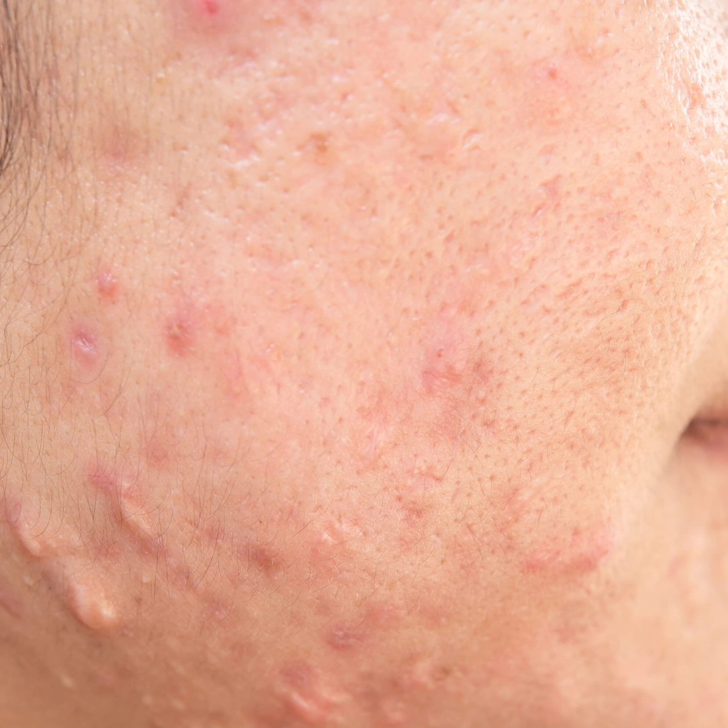 Hypertrophic or Keloid Scars