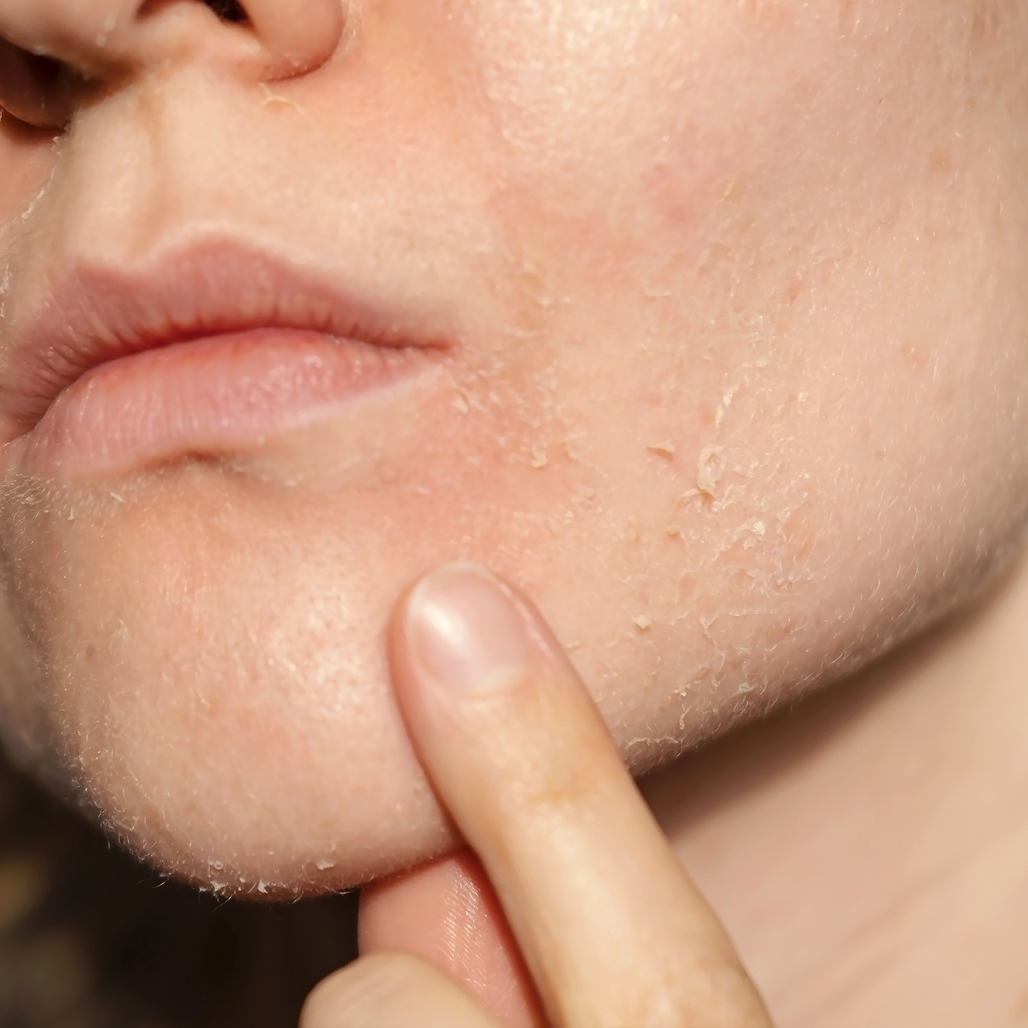 Impaired or Weakened Skin Barrier