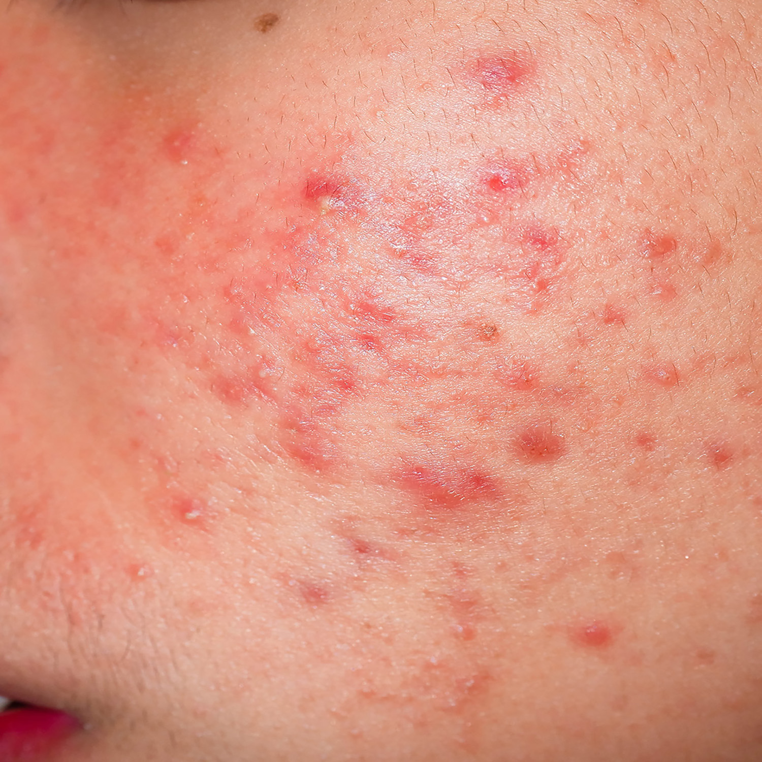 Inflammatory Acne