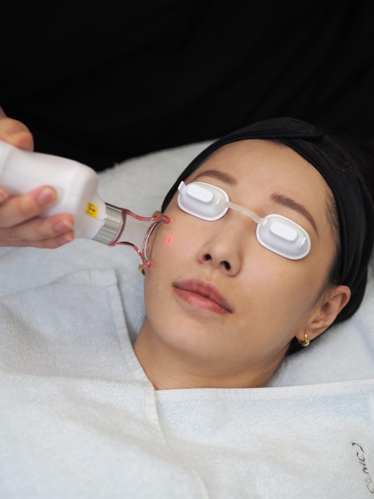 Doctor performing a laser removal treatment on a patient's cheek with protective eye shields in place