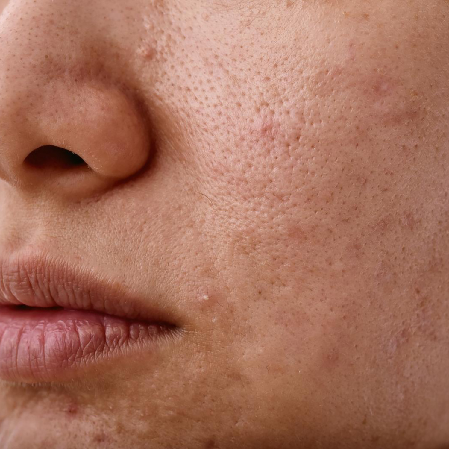 Loss of Collagen & Elasticity