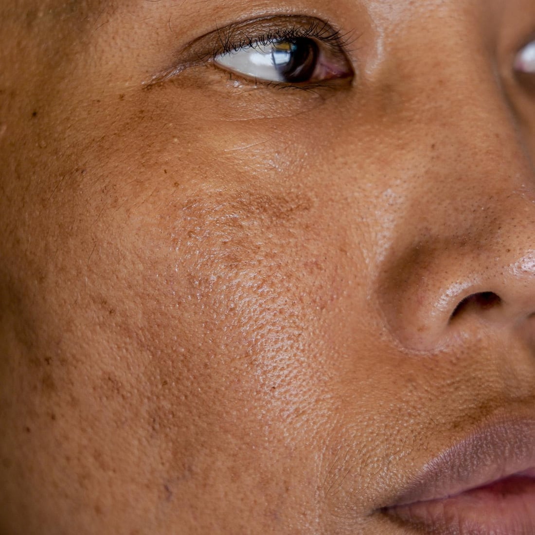 Close-up of skin texture and uneven tone associated with melasma