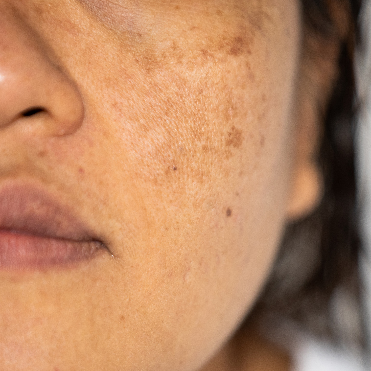 Post-Inflammatory Hyperpigmentation (PIH)