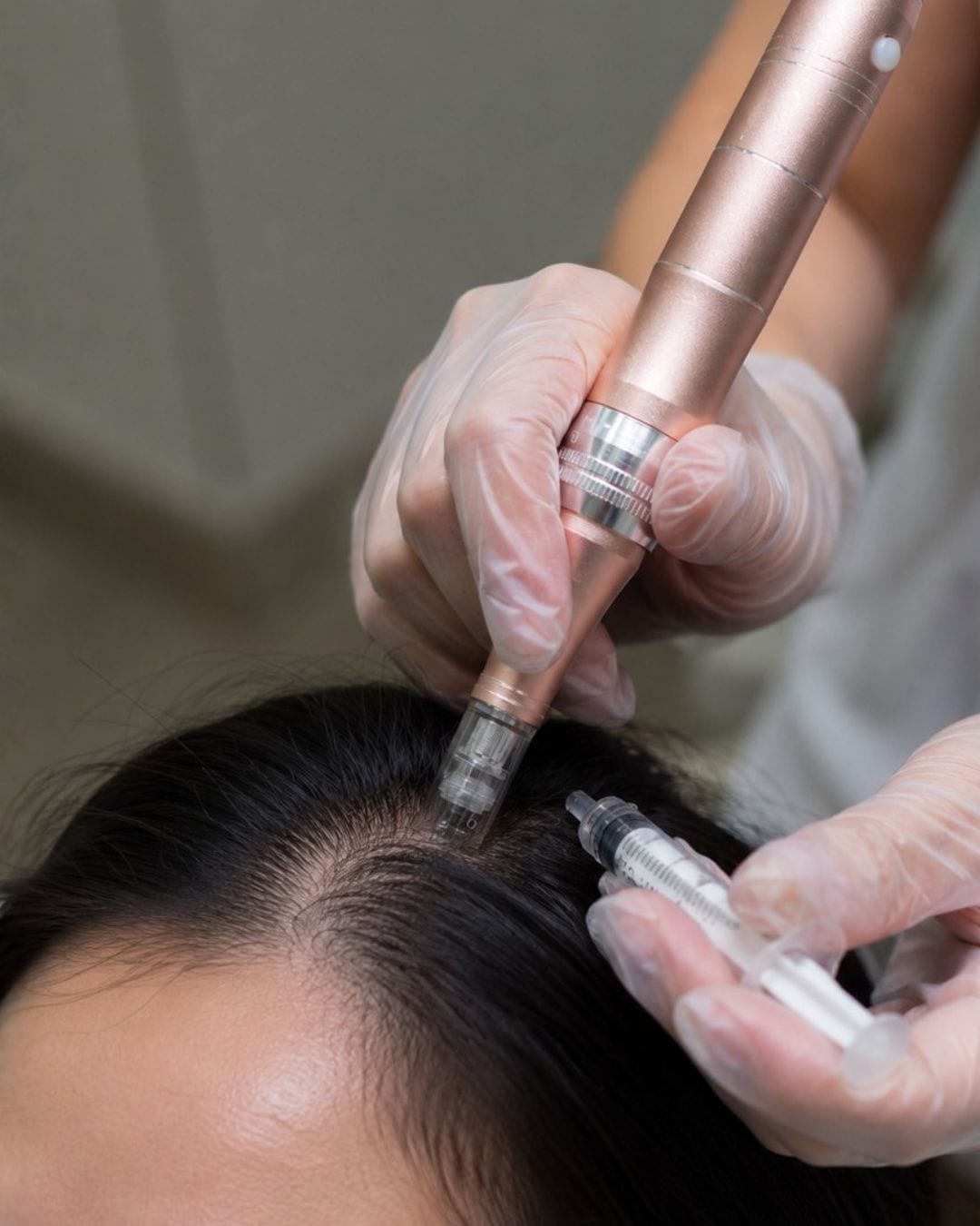 Clinician delivering a microneedling scalp treatment along the hairline at Reborn Skin Clinic