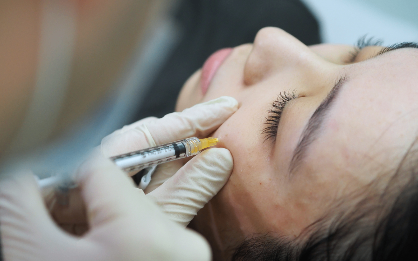 Sculptra Collagen Stimulator