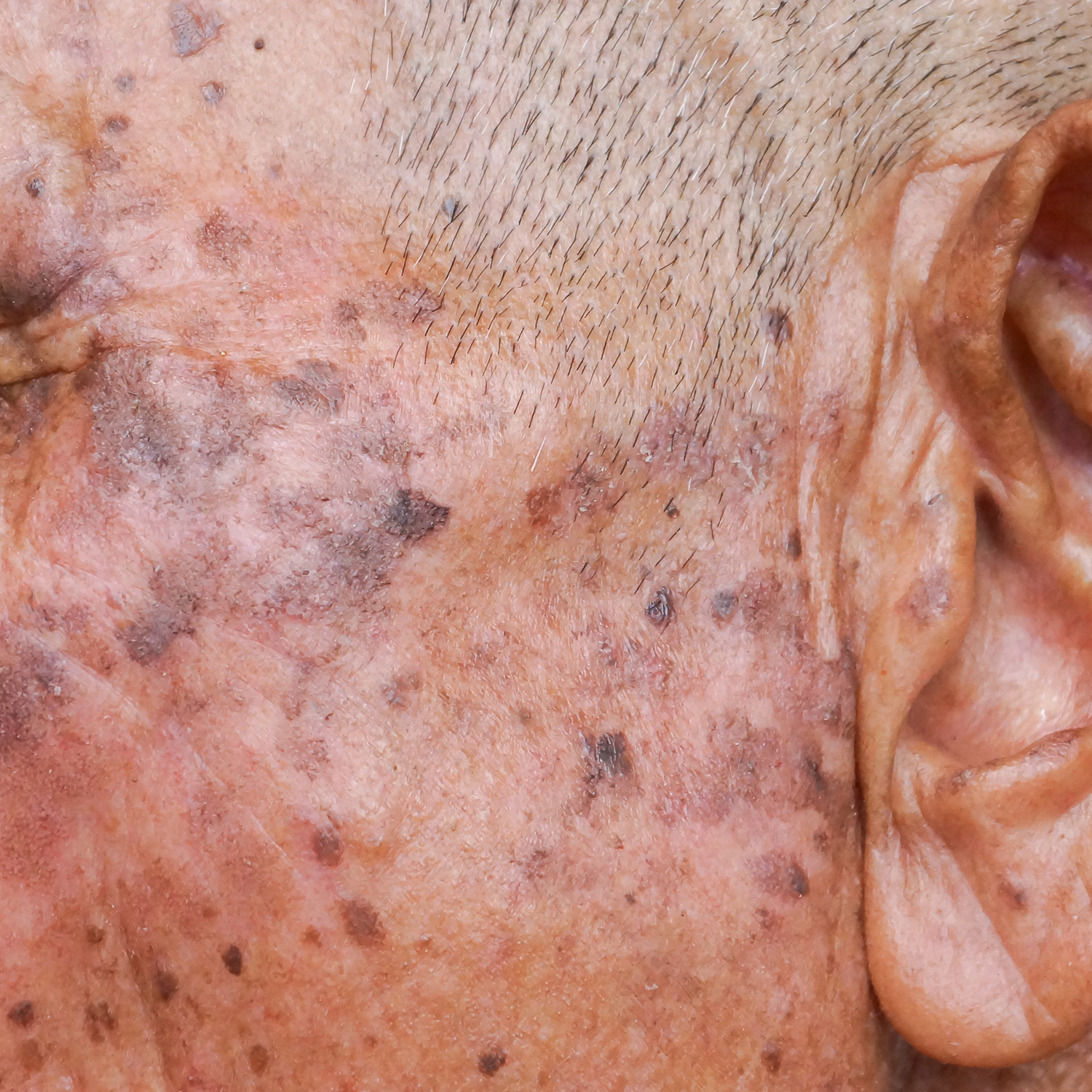 Seborrheic Keratosis