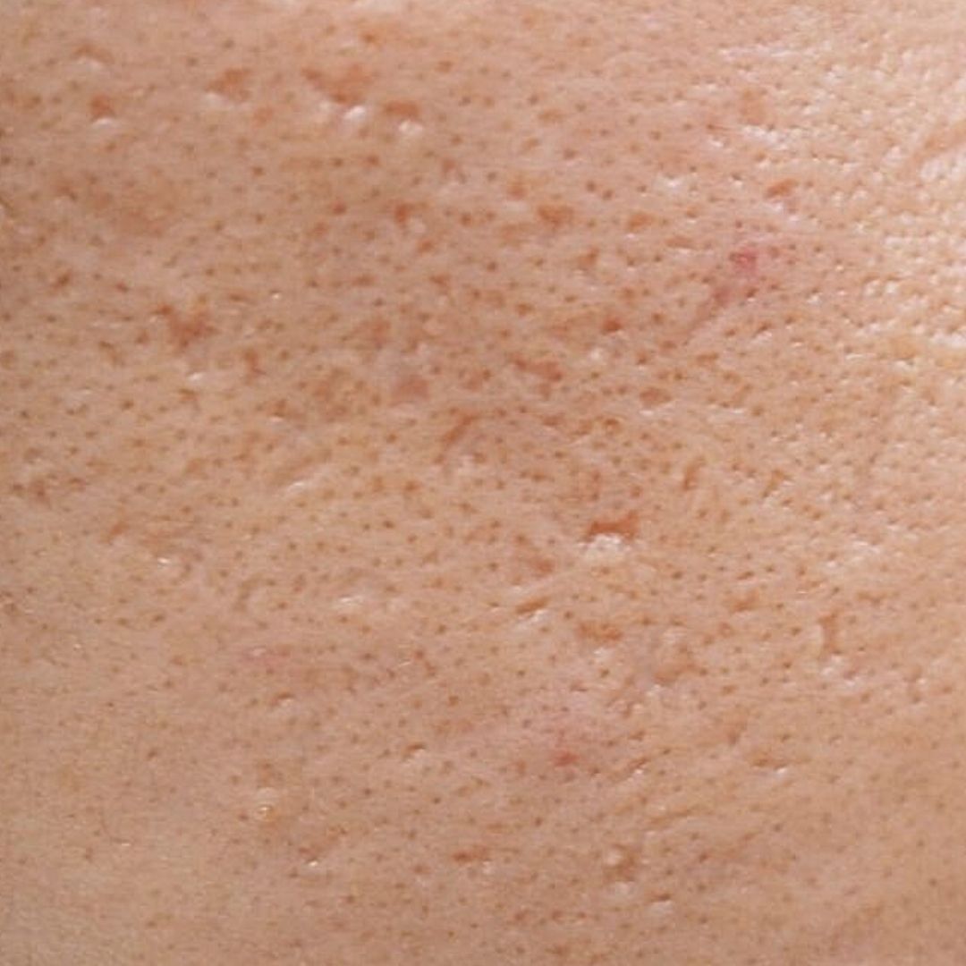 Acne Scars