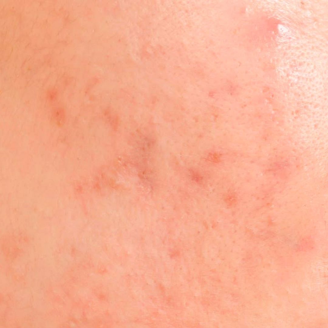 Active Acne