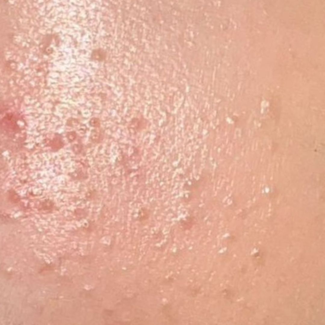 Clogged Pores