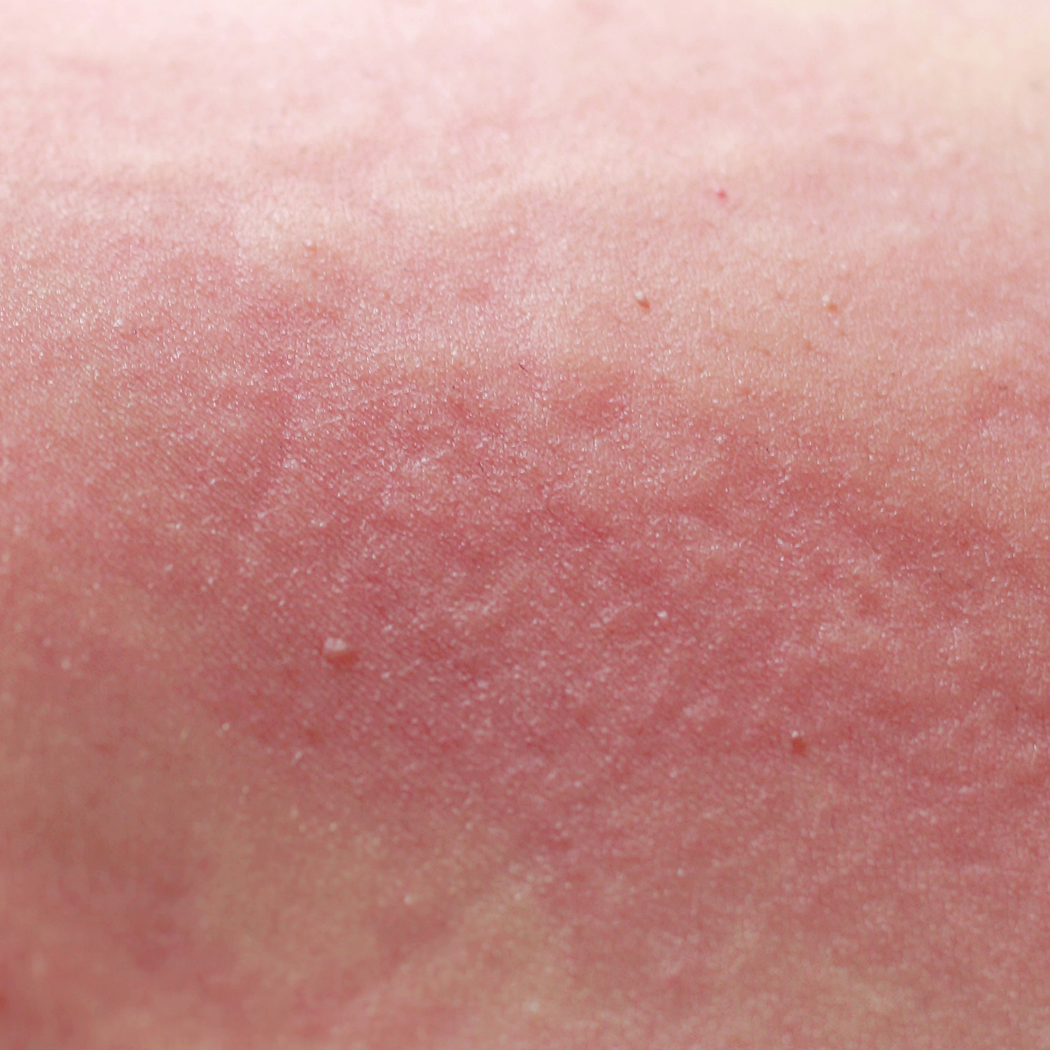Weakened Skin Barrier