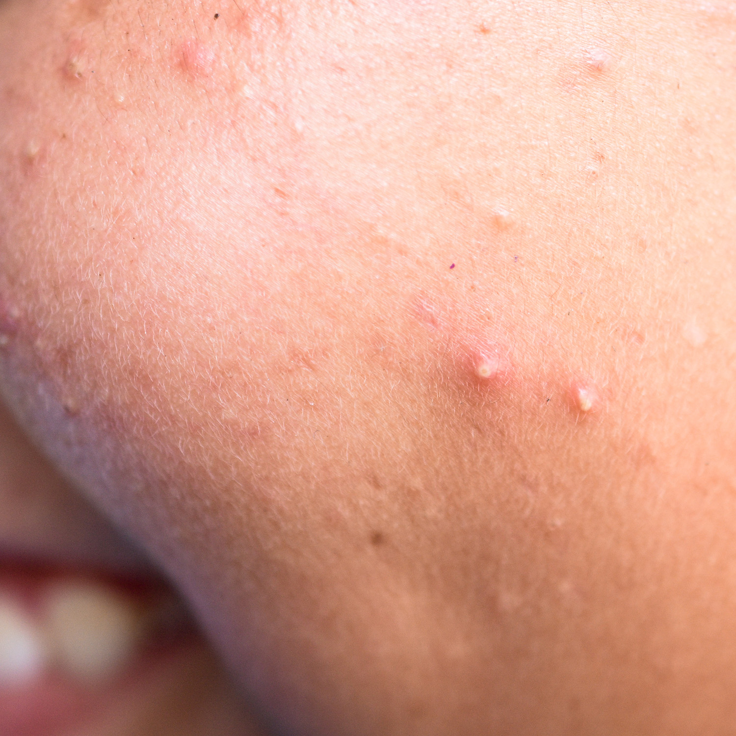 Whiteheads (Closed Comedones)